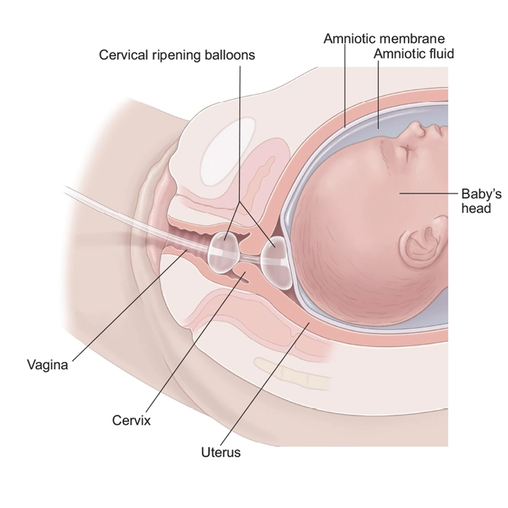 Disposable Silicone Cervical Ripening Double Balloon Dilation