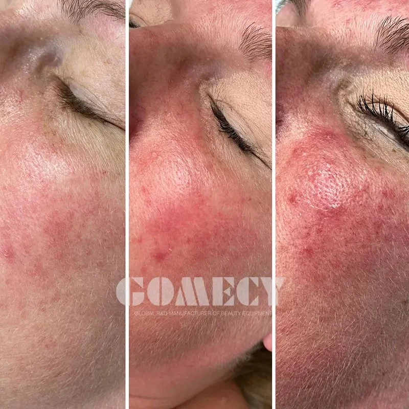 M22 Laser-Akne-Behandlung IPL Opt E-Light Skin Rejuvenation Dry Augengefäß-Haarentfernungsmaschine