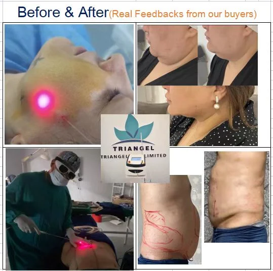 Triangelmed Tragbarer medizinischer Faserlaser Power-Assisted Vaser Liposuction Laser 980nm Plastischer Chirurg Fettentfernung Lipolyse Laser-Gerät 982nm 1470nm