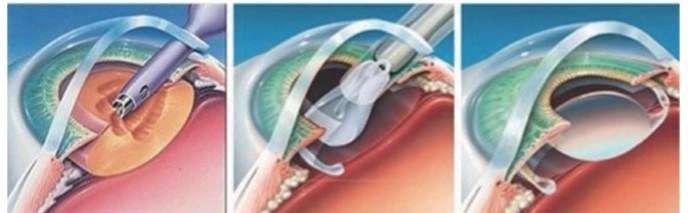 1.0Ml, 15mg/ml sem descolamento de retina de esterilização por óxido de etileno a cirurgia de gel de ácido hialurônico