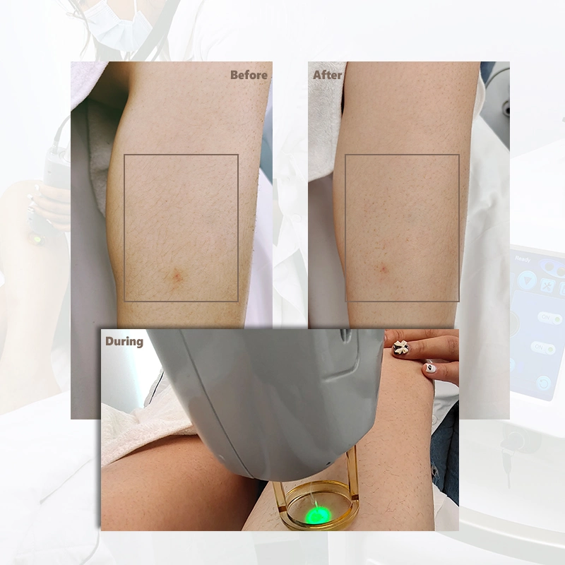 2023 Newest 1064 Fiber Coupled Long Pulse ND YAG Laser Hair Removal/Alex Laser Alexandrite Facyory Price