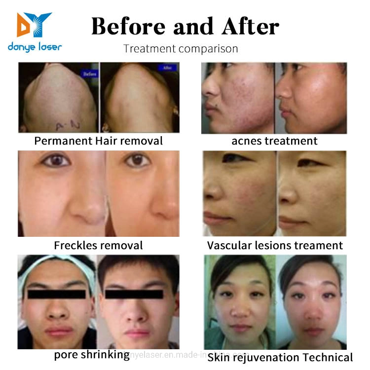 Tratamiento de acné con láser para eliminar el vello de la piel aprobado por la CE Máquina de terapia 2021