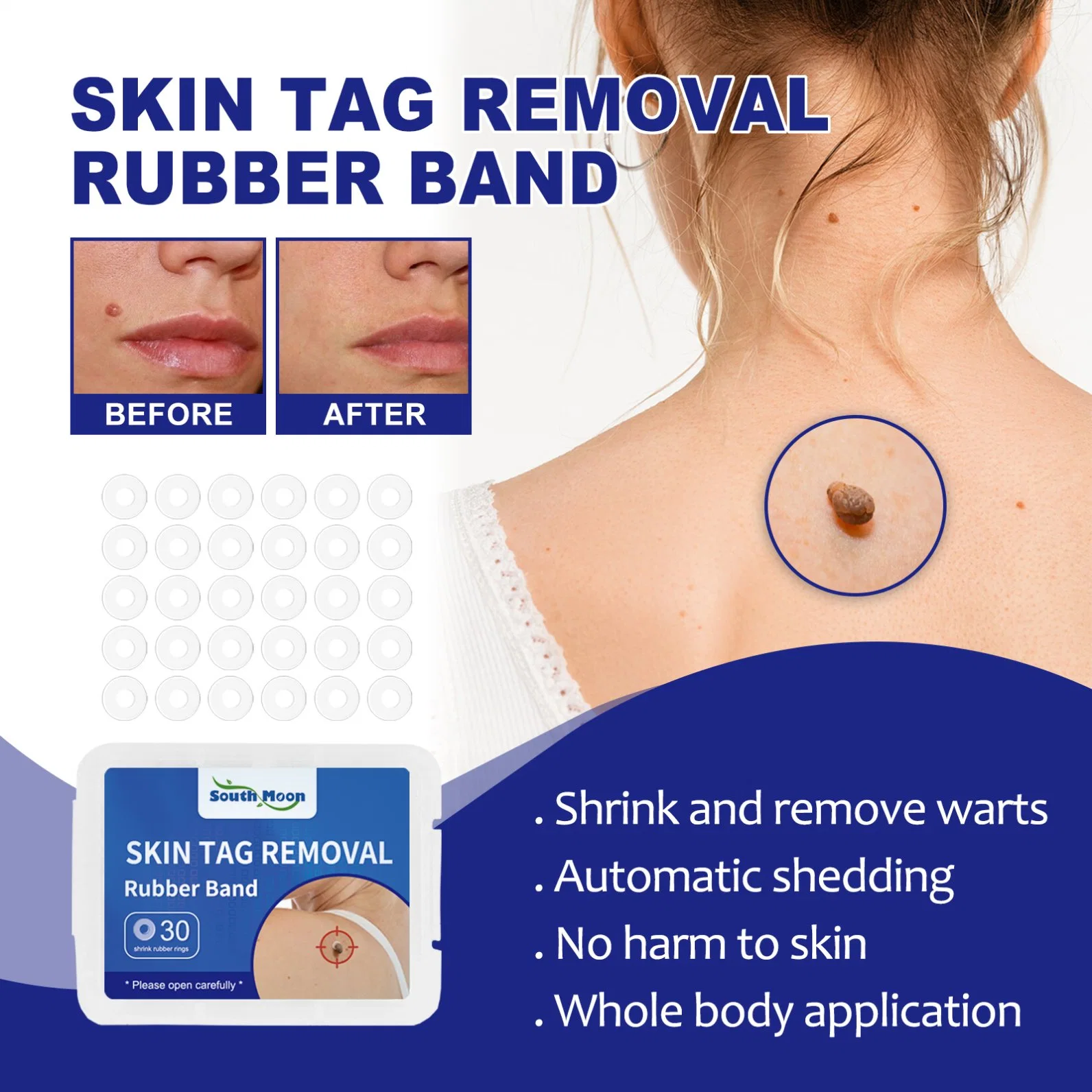 Skin Tag Remover Band Mole Wart Acne Pimple Patch Removal Spot