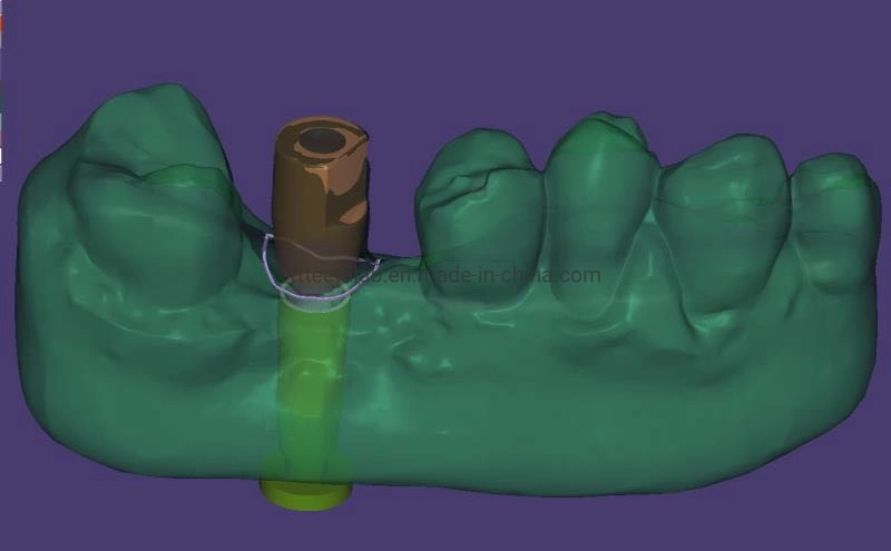 Digital Dental Implant Supplies Ceramiccrown Material Instrument Made From China Dental Lab Dental Implant