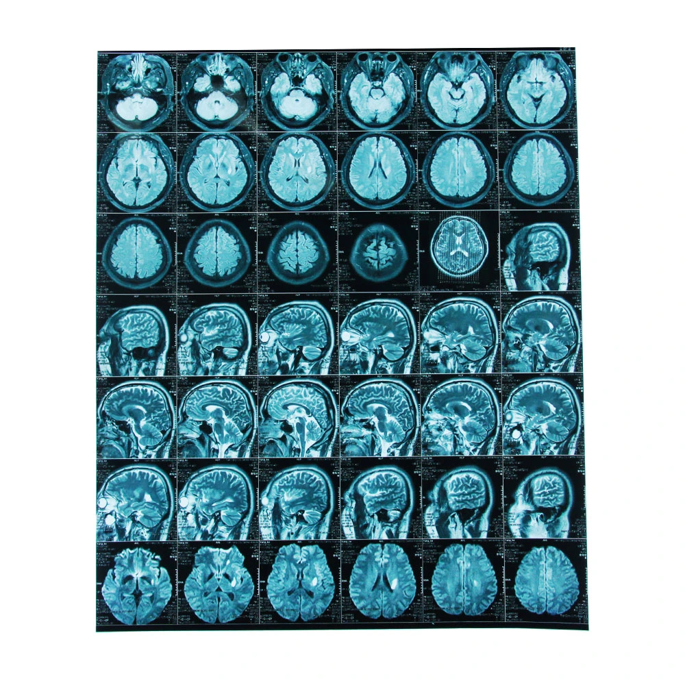 Mayorista/Proveedor para película de rayos X médica de inyección de tinta universal de color azul 175um para el Departamento de Radiología