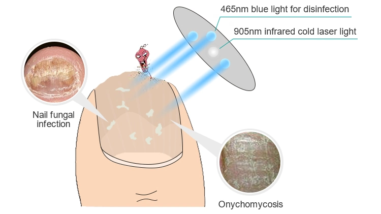 Neueste Laser-Behandlung Gerät für die Tötung Nagel Pilz beliebt bei Medizinische Messe in Indien