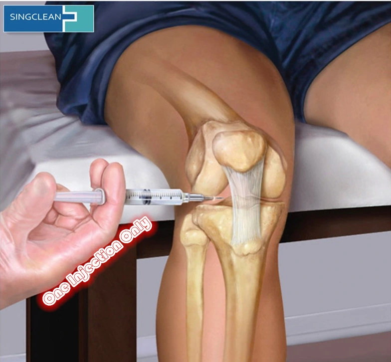 Singjoint Hyaluronic Acid Injections for Knee Osteoarthritis Pain