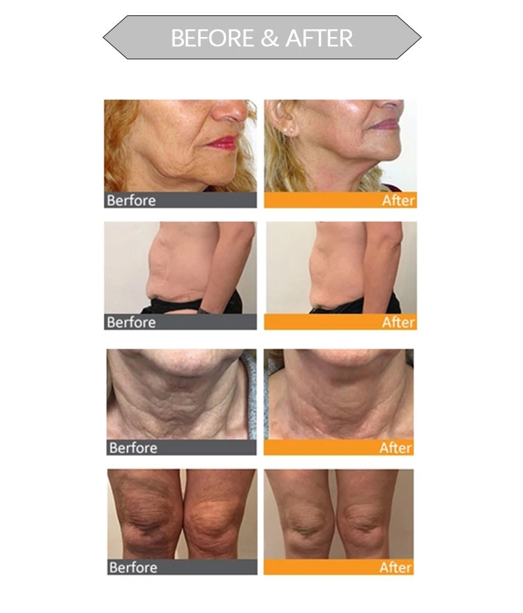 3-in-1 Lipo V-Max SMAS de levantamiento de cara 4D SMAS Eliminación de grasa piel de la máquina de belleza de apriete