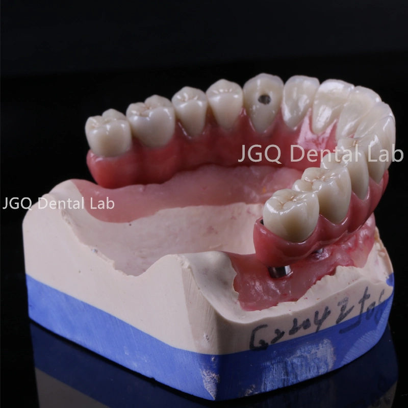 Suministros de implantes dentales All-on-6 Full Contour Zirconia implante dental superior Puente