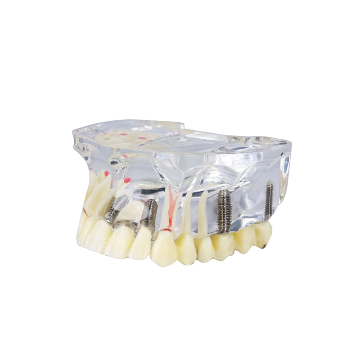 Implant Model for Showing Implant and Restoration Caries