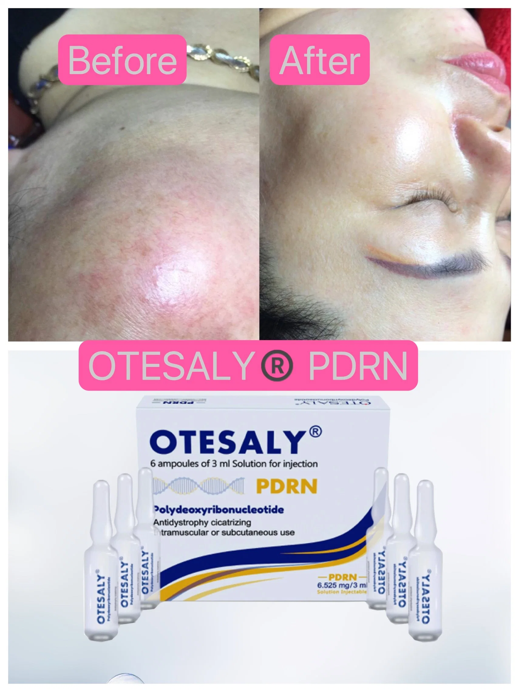 Amostra grátis Otesaly Meso Pdrn 18ml ampolas cicatriz Anti-Wrinkles Solução Rejuvenescimento Mesoterapia Pdrn Anti-Aging Injecção