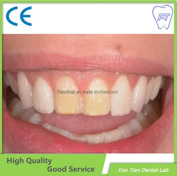 Professional Services Bruxzir Solid Stable Zirconia Bridge From China Dental Lab