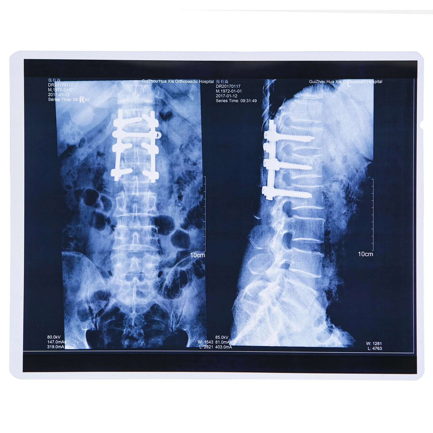 Medical Film Xray Image Printing Use Blue Xray Film Pet Medical Film