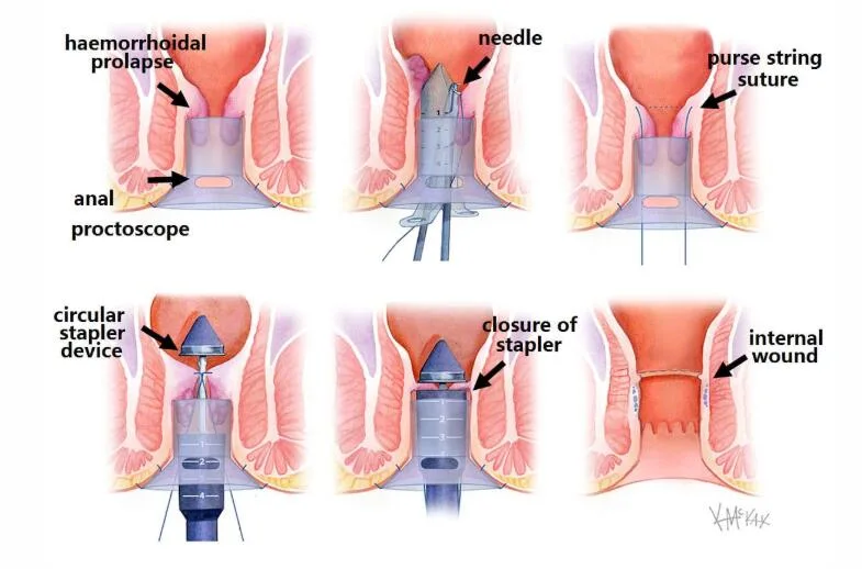 El mejor tratamiento con láser de diodo láser médico Cirugía de hemorroides con 980 Nm 1470 Nm Proctología