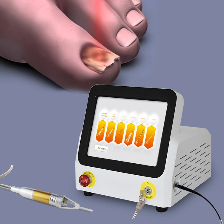 980nm Diode Laser for Portable Nail Fungus Onychomycosi Most Effective Podiatry Equipment