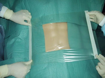 Surgical Adhesive Dressing Film/Disposable Surgical Membrane/Medical Incision Dressing Drape