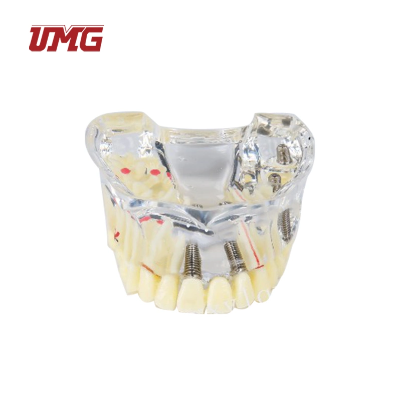 Implant Model for Showing Implant and Restoration Caries