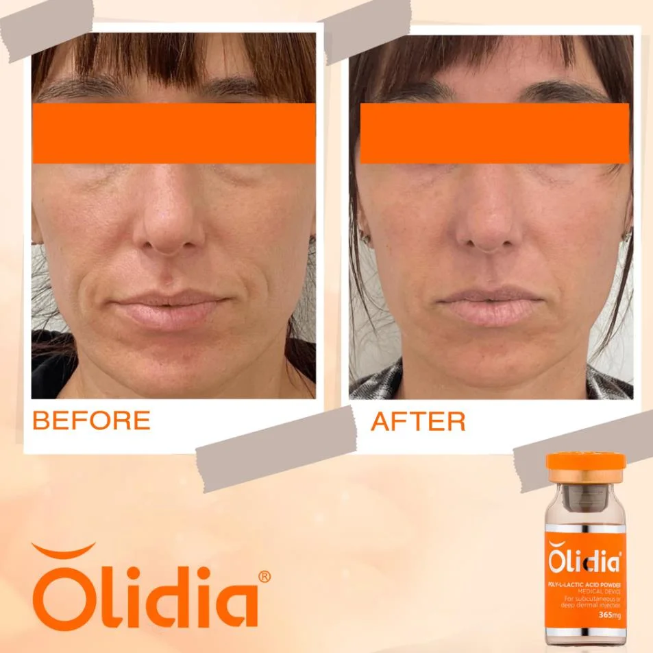 Новый CE Olidia Devolux Plla Collagen dermal присадочный полимерный L-молочный Кислотный порошок 365 мг Астестетинал Этребелле Беллона PCL