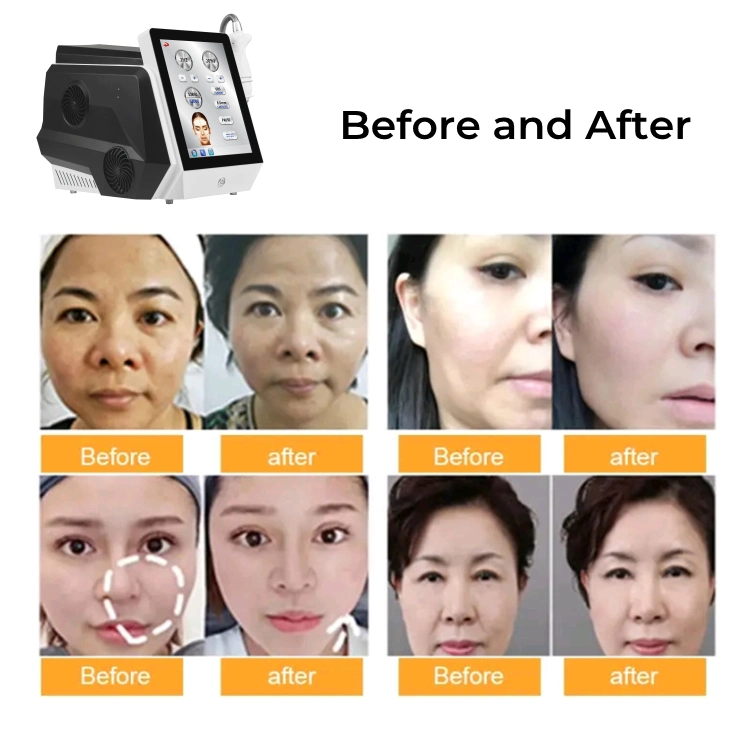 Frozen Hifu 2022 New Hifu Machine with Cooling System 62000 Shots Wrinkle Removal Ice Hifu Weight Loss Skin Care Anti-Aging Ultrasound Hifu with CE