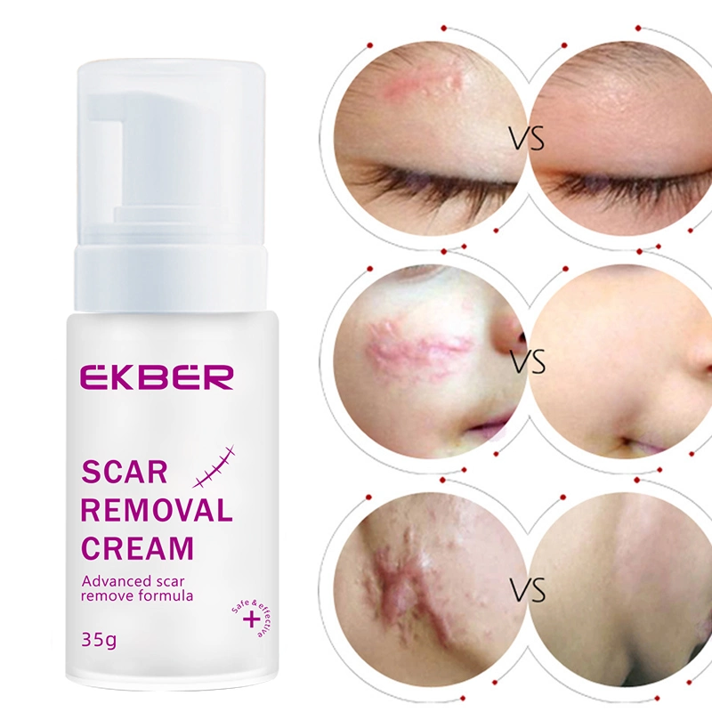 OEM Bura Natural Facial crema eficaz para eliminar cicatrices Anti Acné Cuidado de la piel