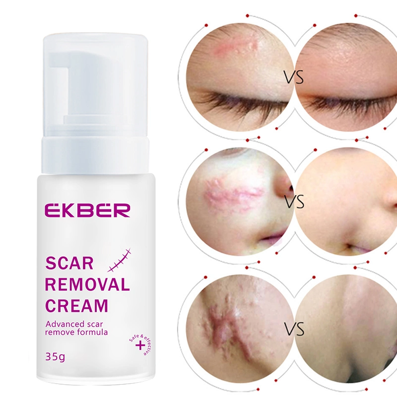 OEM Bulk Pure Natural Facial Effective Scar Removal Cream Anti Acne Skin Care