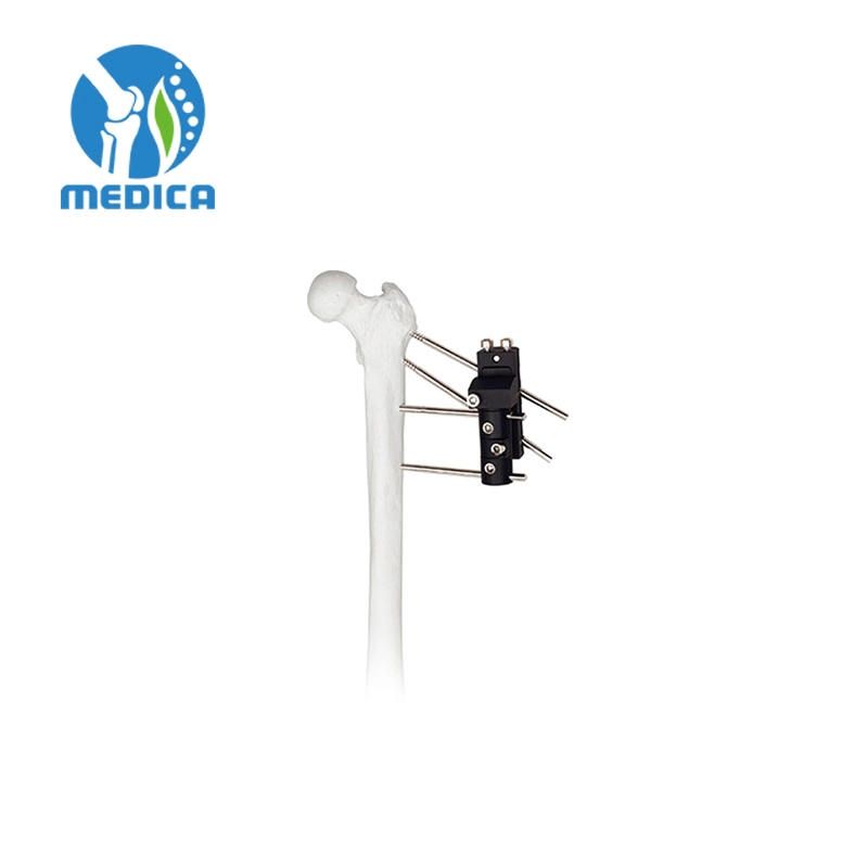 Trauma Orthopedic Single-Sided Integrated Joint External Fixation Elbow Joint External Fixator