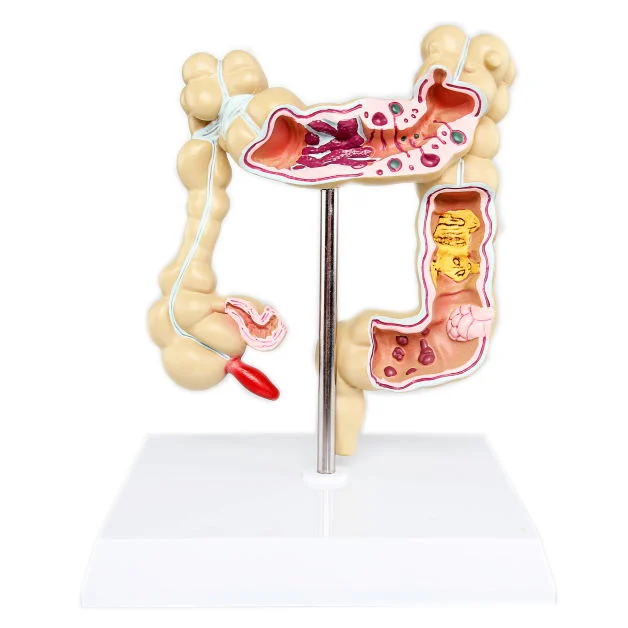 High quality/High cost performance  Medical Diseases Colon Model