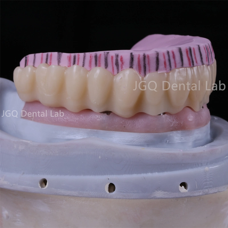 Dental Products Vollbogen Zirconium Implant Bridge mit verschraubtem Titan Implantat