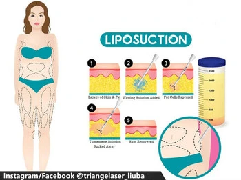 Tratamiento de cirugía mini-invasiva con láser para levantar y reafirmar el rostro. Equipo médico de lifting facial Endolift de 1470 nm.