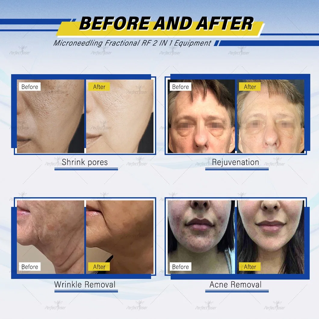 Morpheus 8 microneedle superfacial Vivace Eliminación de arrugas Anti-Aging Stretch Mark Eliminación Rejuvenecimiento de la piel Fractional Microneedling Beauty Machine