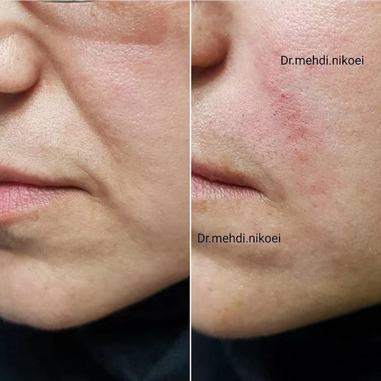 Otesaly 1ml ácido Hialurónico líneas profundas Dermal Filler Cross ligado La piel facial Inyecciónc