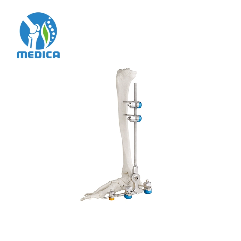 High Quality Combination External Fixator Large Fracture Human Trauma Orthopedic Surgical Ankle Fusion Joint Fixator