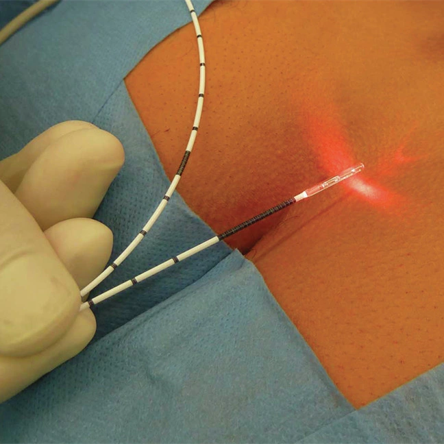 Diode Laser Surgery 980nm 1470nm Hemorrhoid Laser Fiber Proctology Surgery Anal Fistula Radial Fiber
