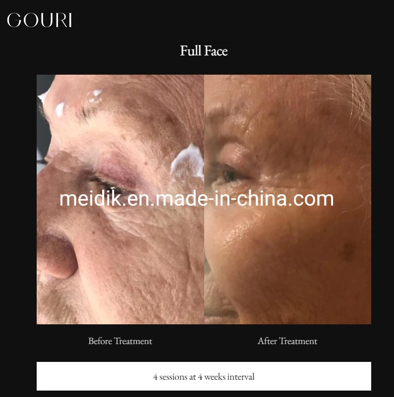 Gouri Filler Goiri Dermal Filler The First Injectable Liquid Polycaprolactone Pcl Premium Collagen Stimulator Face Lift Anti Aging Wrinkles Removal Injection