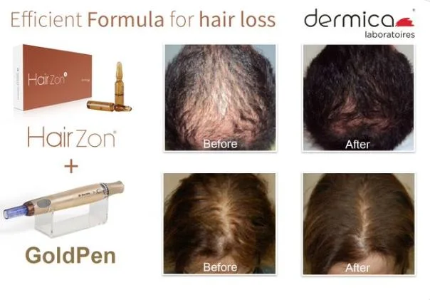 Efficient Formula for Hair Loss Dermica Hair Zon and Goldpen to Treatment Hair Loss Promote The Growth of New Hair